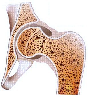 osteoporosi
