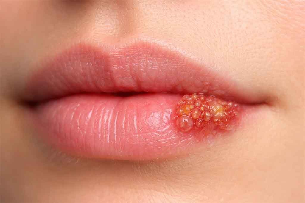 Herpes-labiale