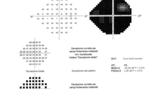 Glaucoma un nuovo caso particolare