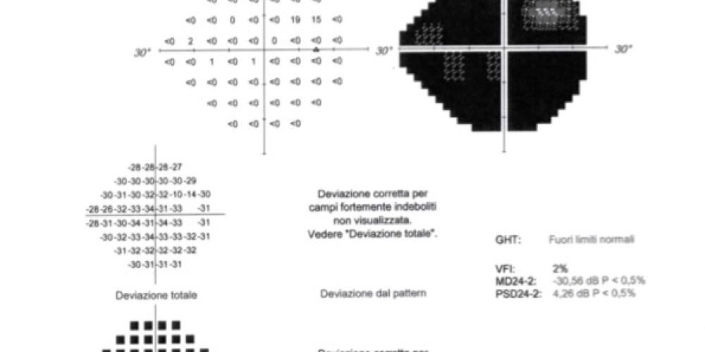 Glaucoma un nuovo caso particolare