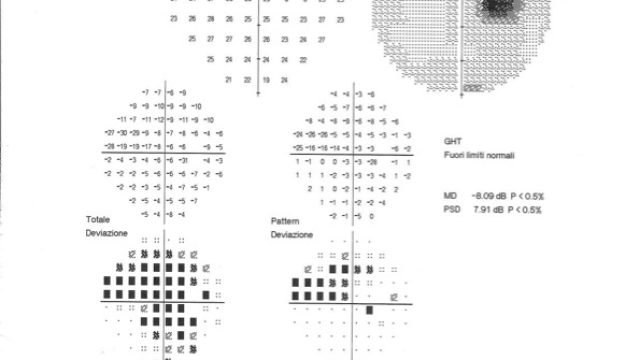 Un glaucoma di difficile gestione