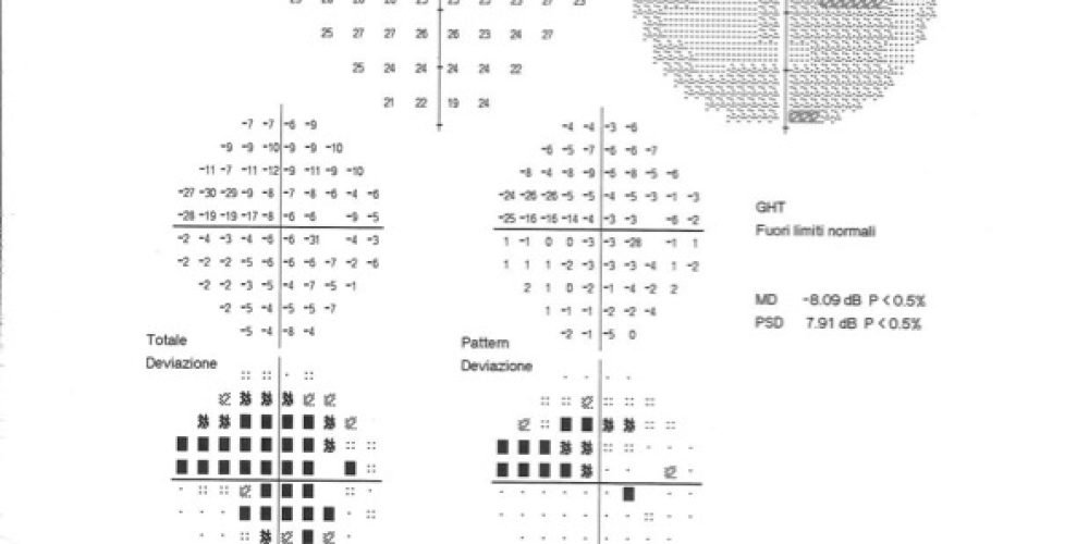 Un glaucoma di difficile gestione