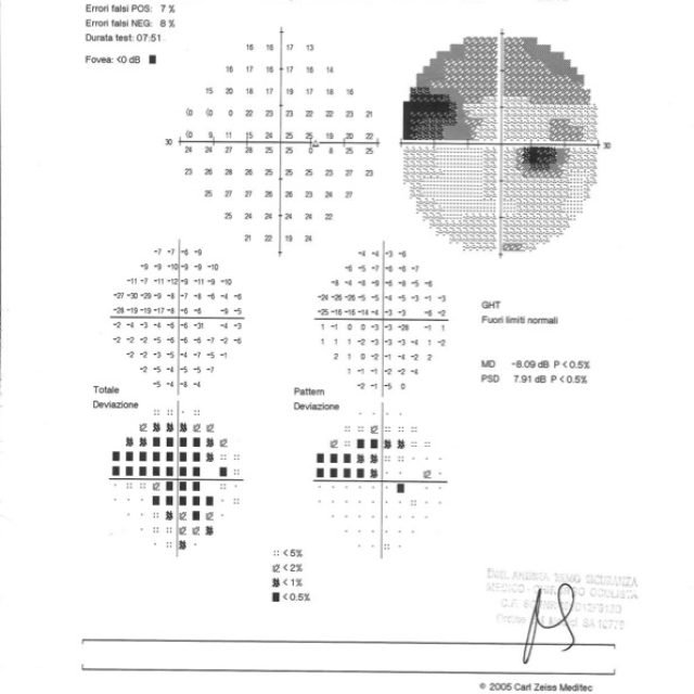 Un glaucoma di difficile gestione